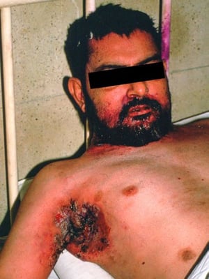Pemphigus végétans