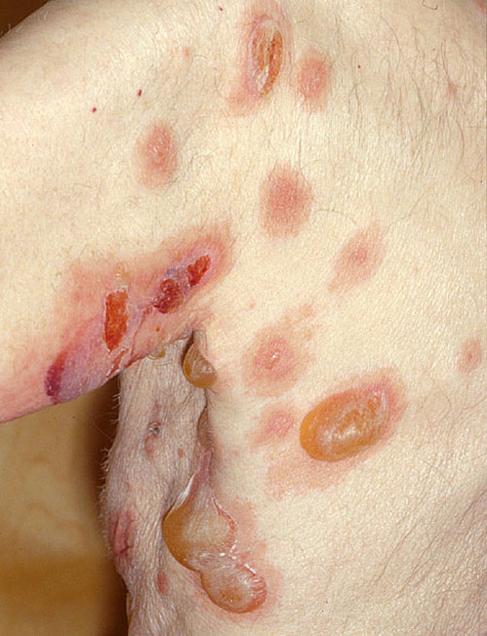 Pemphigus Vulgaris (Flaccid Bullae)
