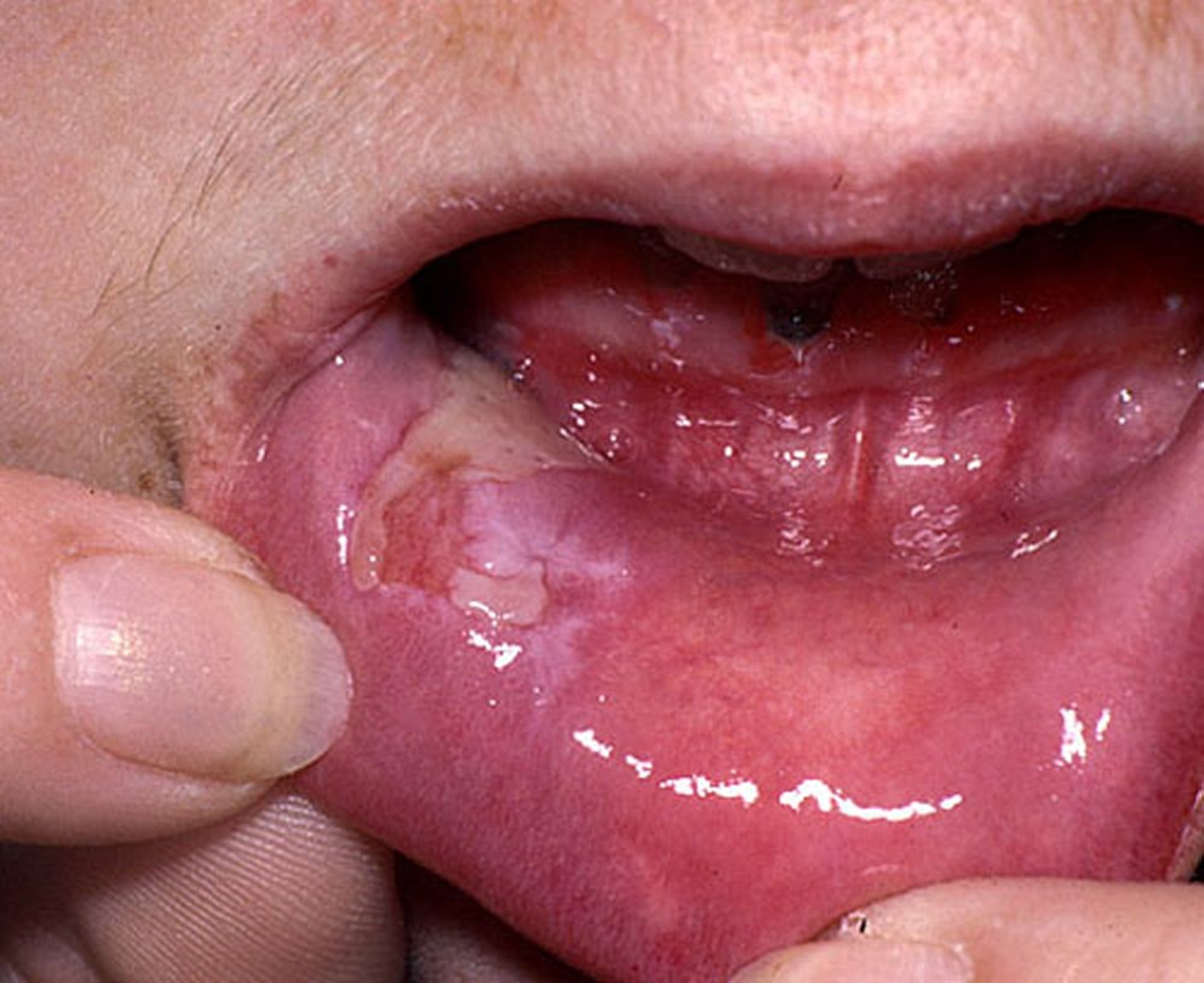 Pemphigus Vulgaris (Oral)