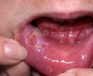 Вульгарная пузырчатка (в полости рта)