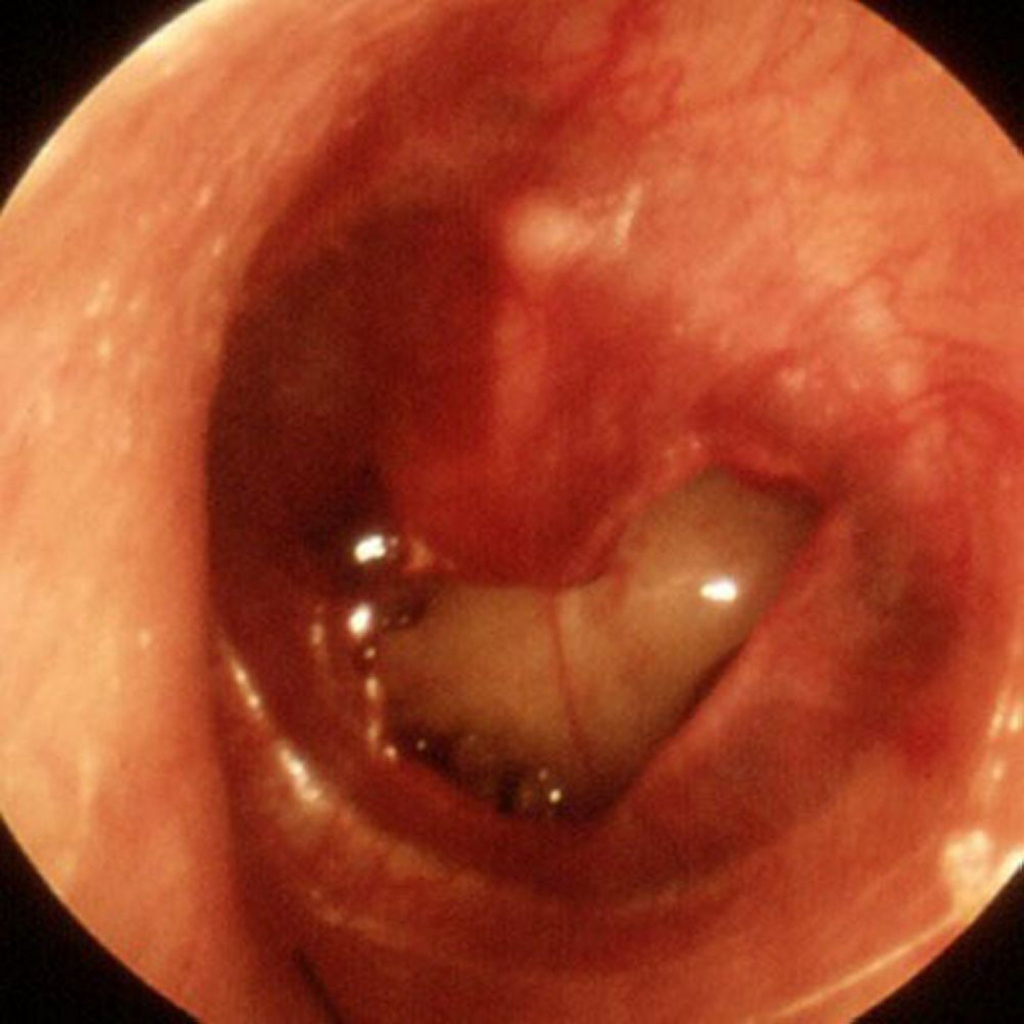 Perforation traumatique du tympan