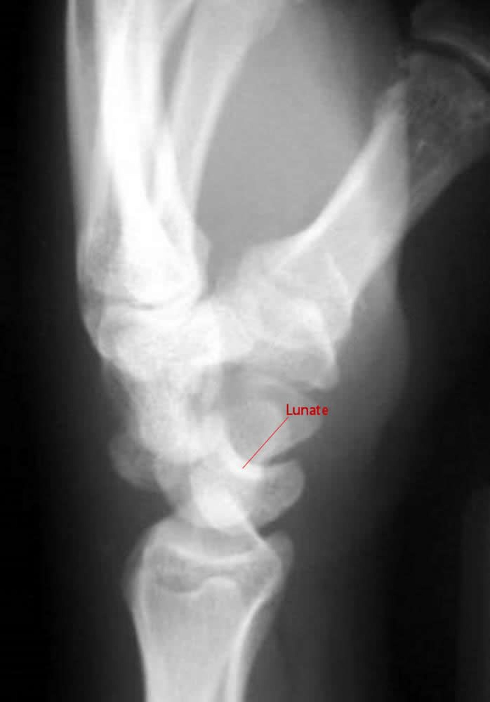 Перилунарный вывих кисти