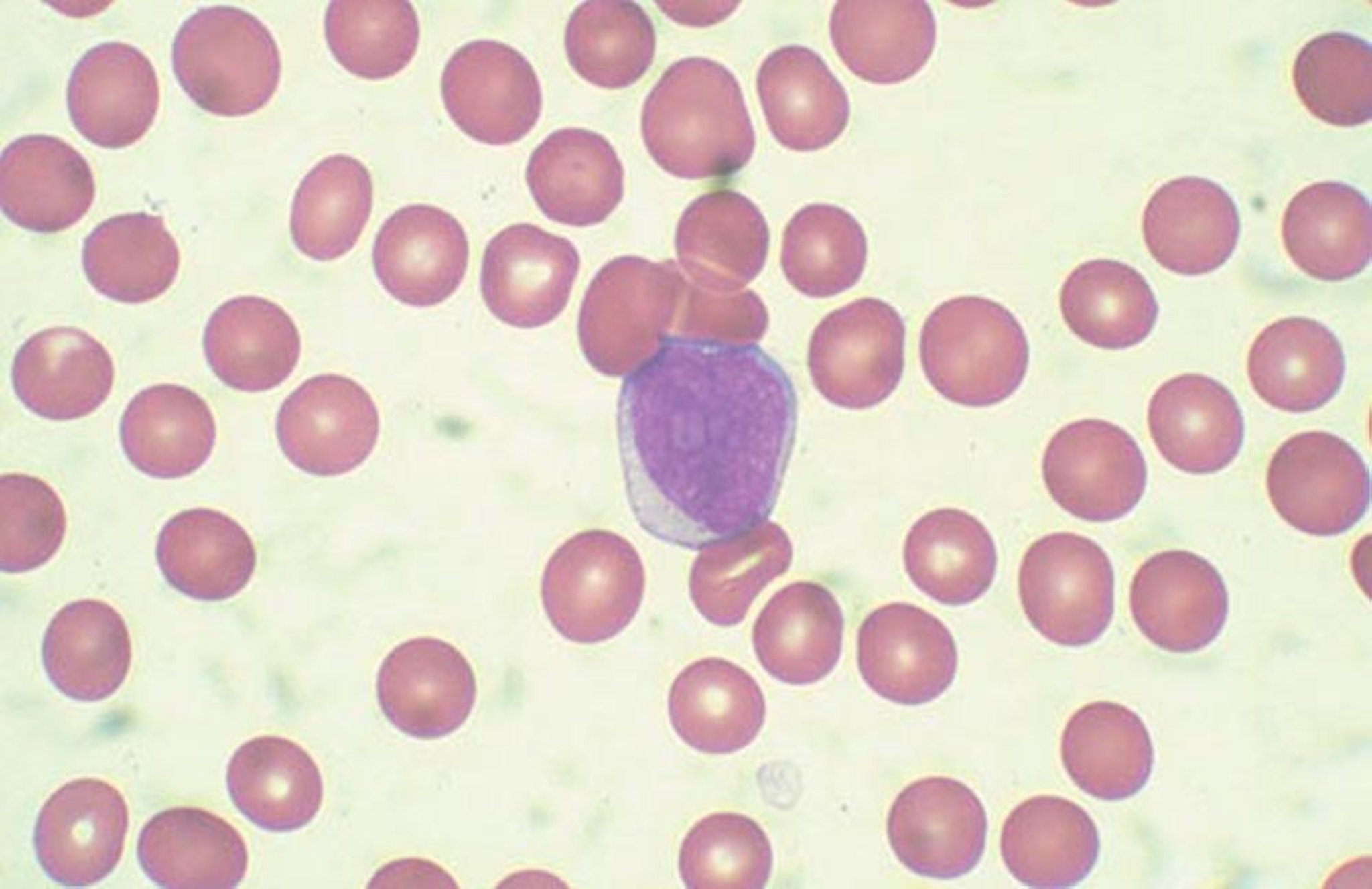 Cellules blastiques sanguines périphériques