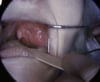 Peritonsillar Abscess