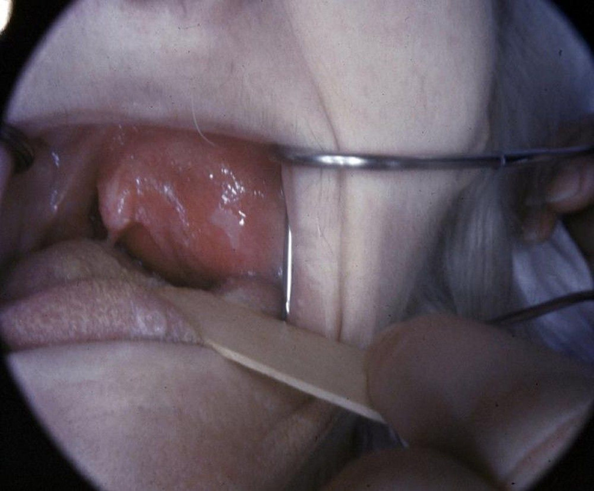 Peritonsillar Abscess