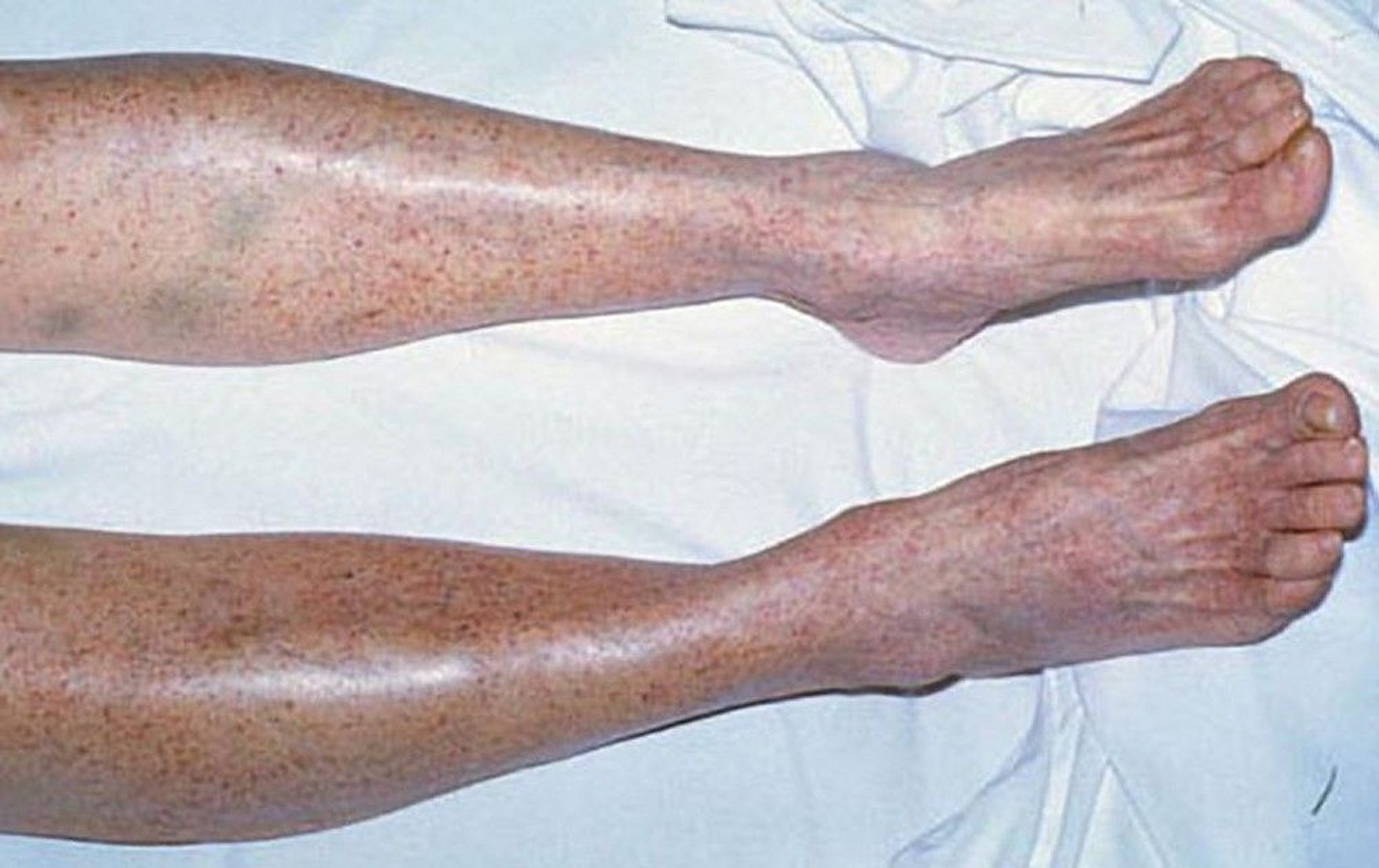 Petechiae in Immune Thrombocytopenia (ITP)