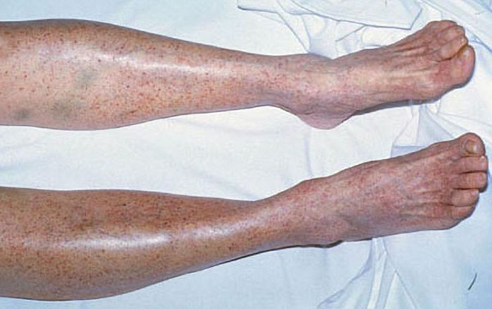 Pétéchies dans la thrombopénie immunitaire