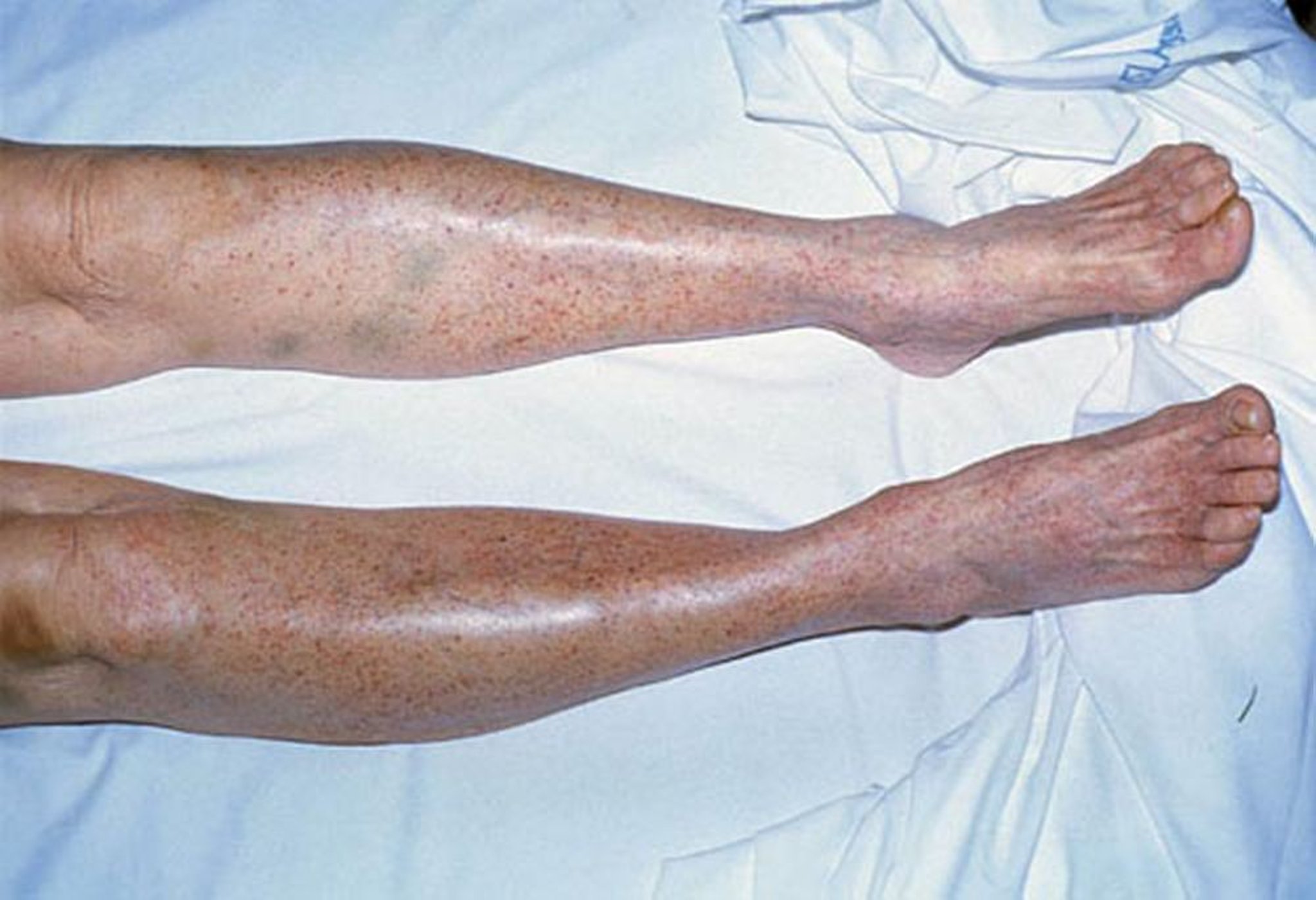 Petecchie nella trombocitopenia immune