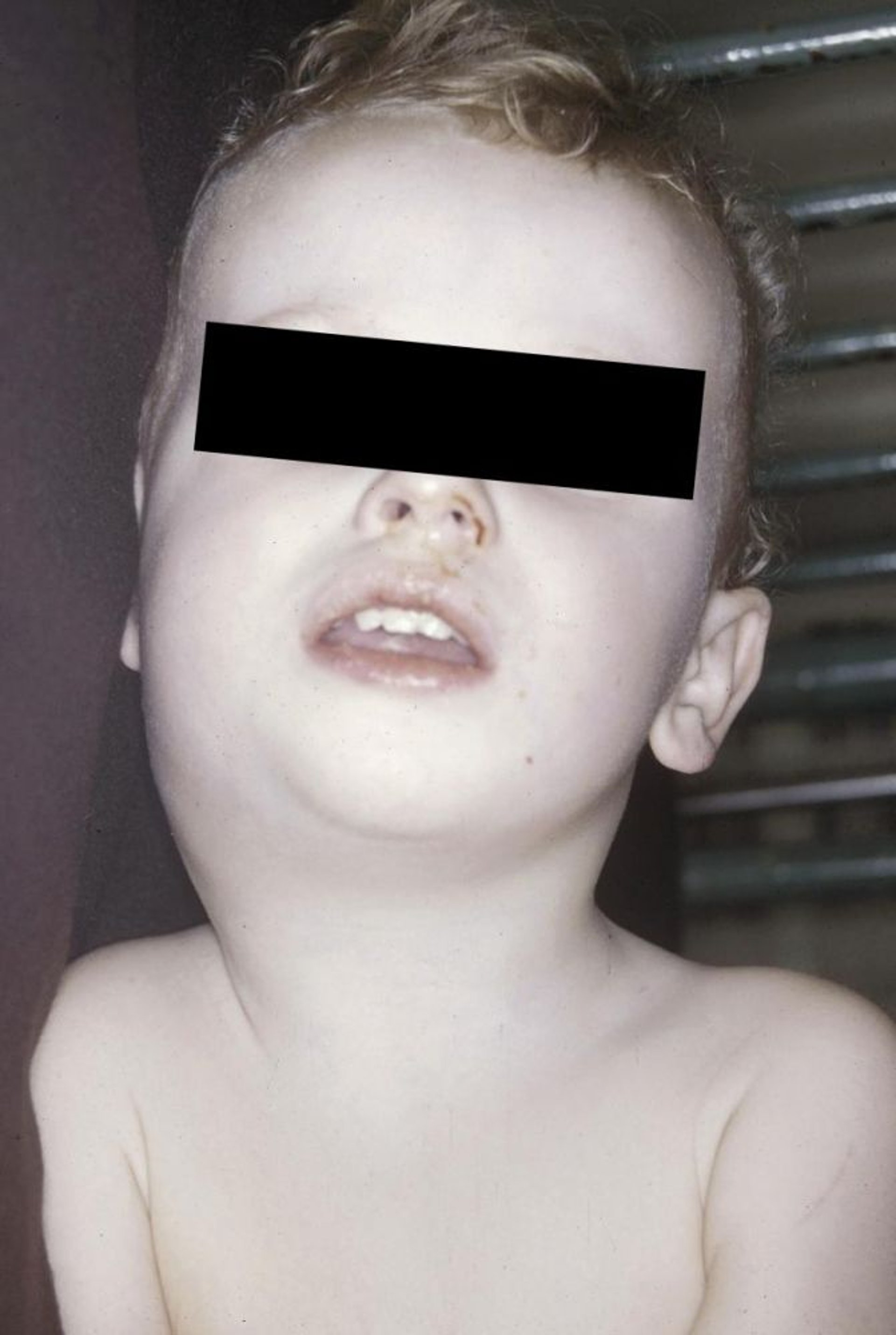 Глоточный абсцесс