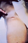 Bubon pesteux (inguinal)
