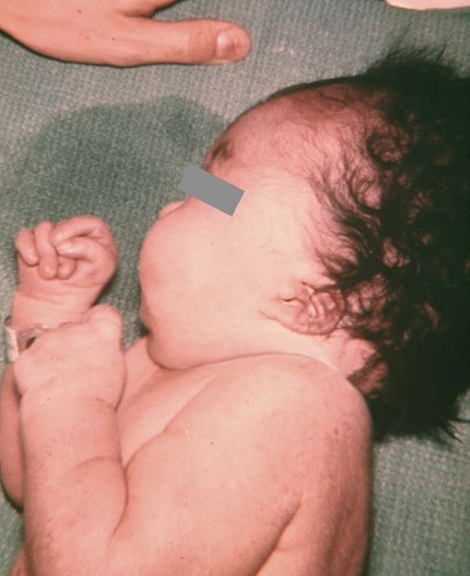 Low-Set Ears in an Infant With Trisomy 18