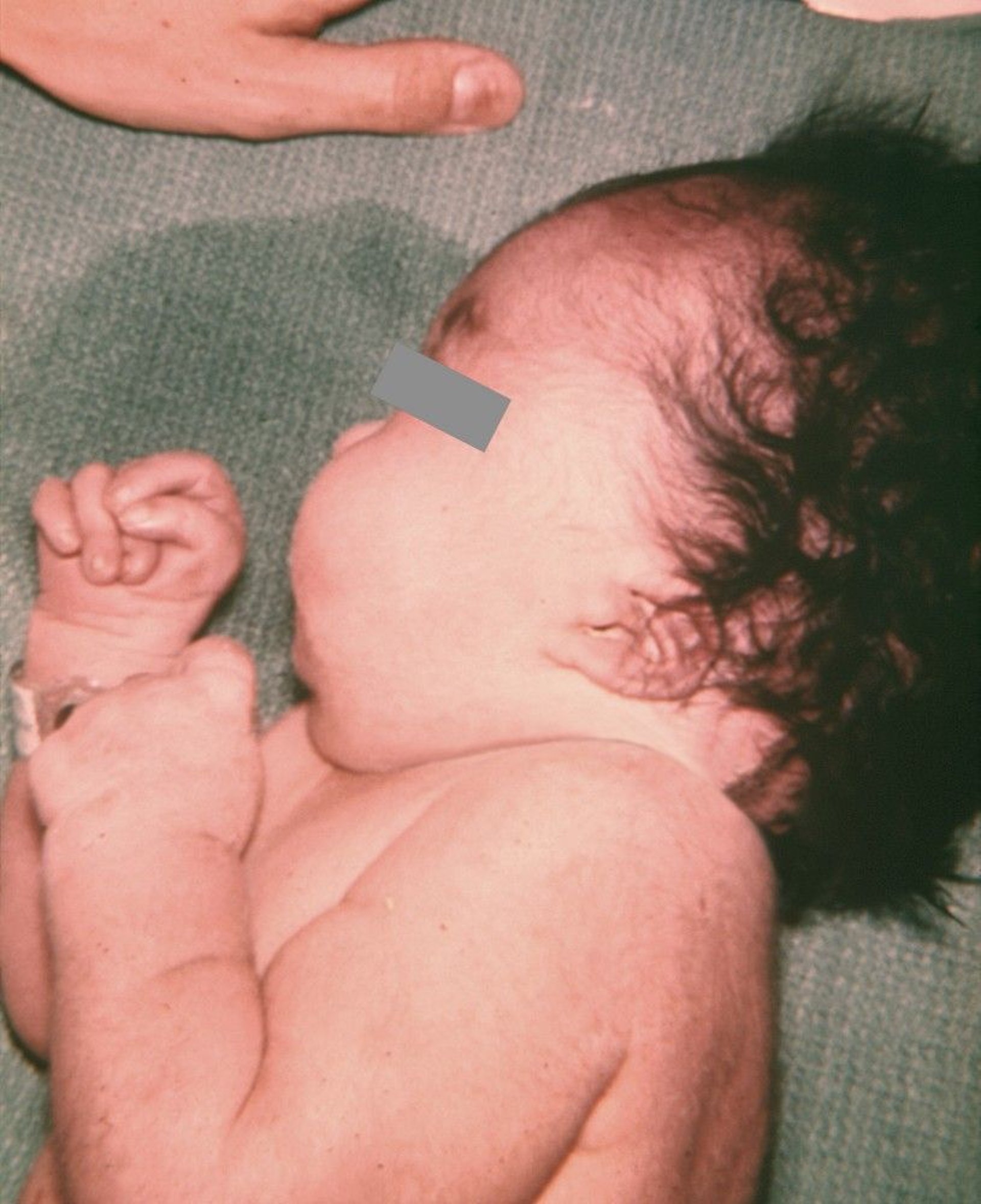 Low-Set Ear and Clenched Fists in Trisomy 18