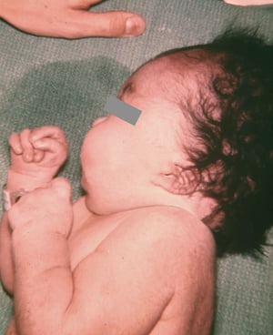 Orecchio a basso impianto e pugni serrati nella trisomia 18