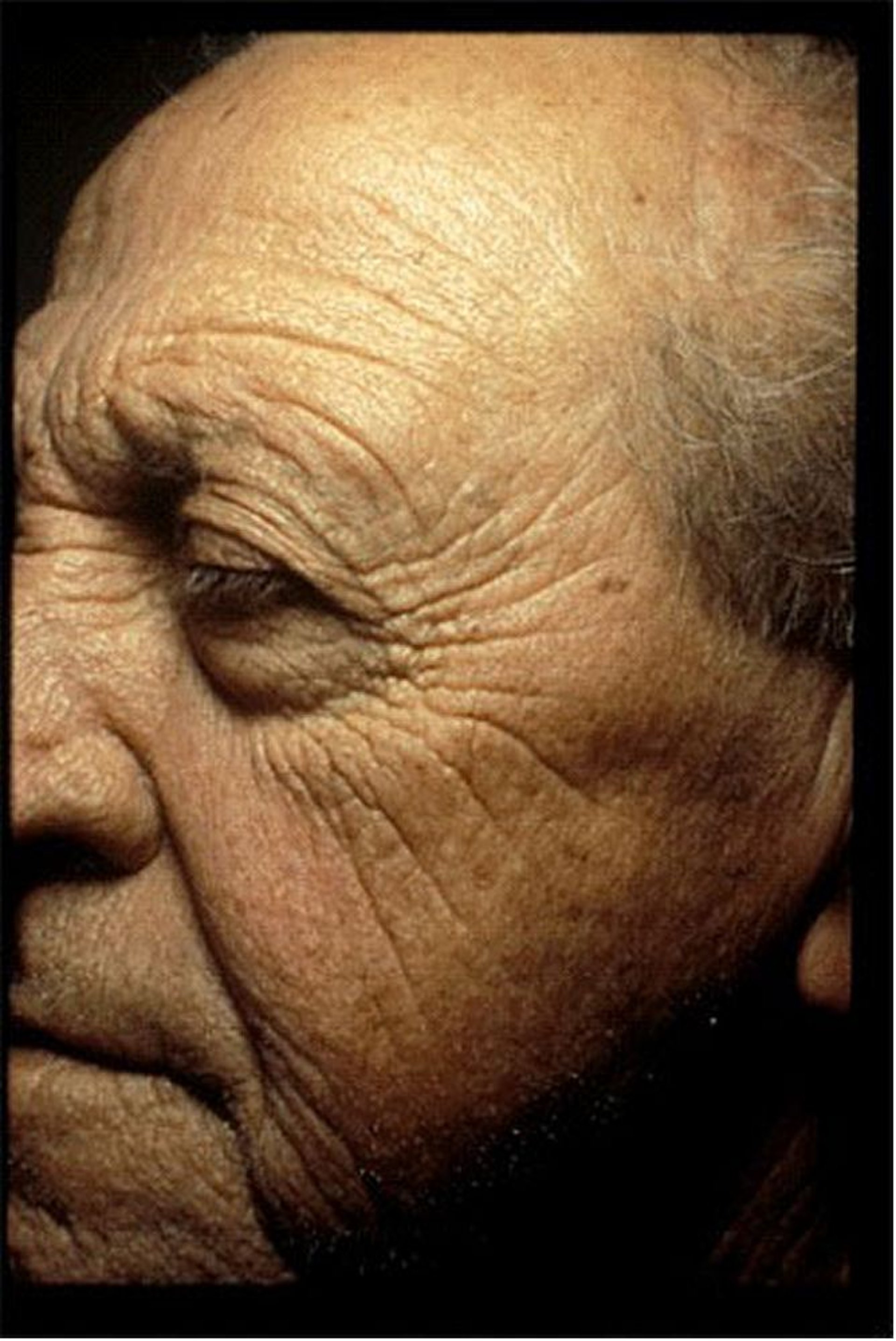 Photoaging