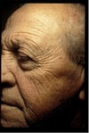 Photoaging