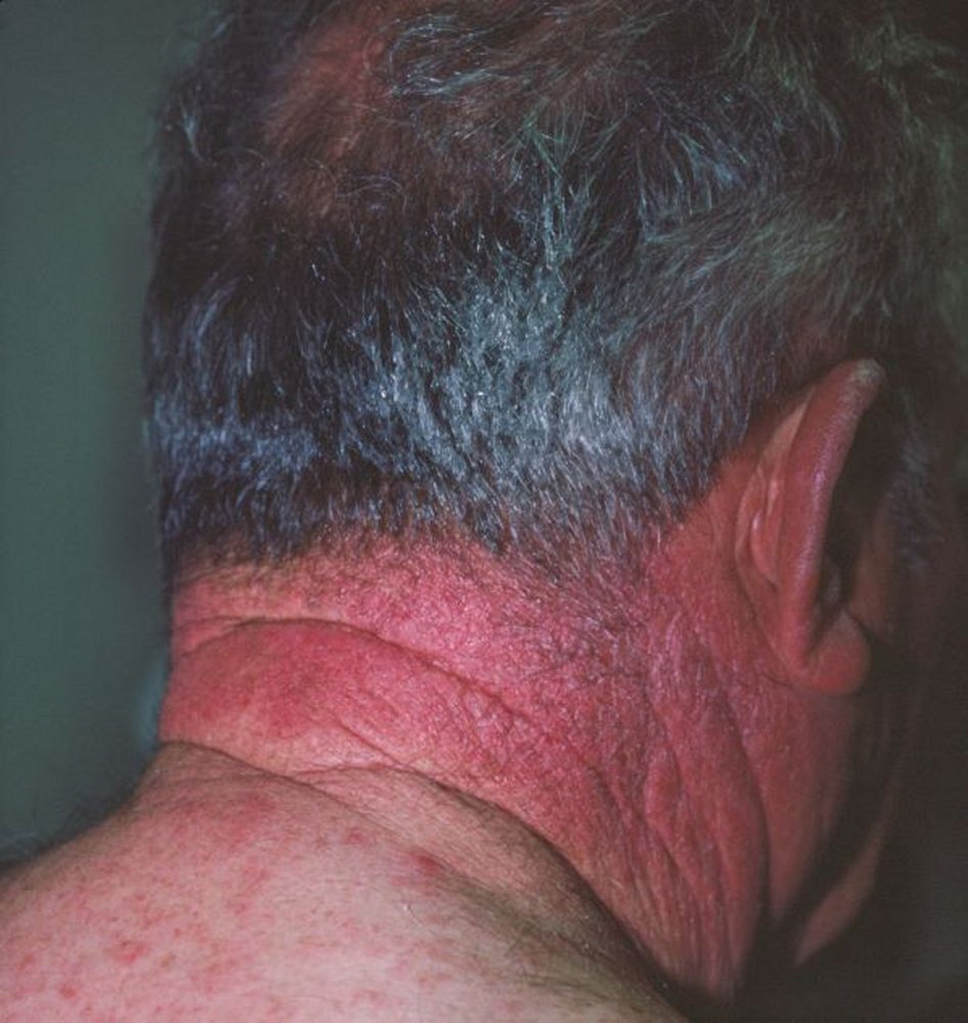 Photosensitivity (Hydrochlorothiazide)