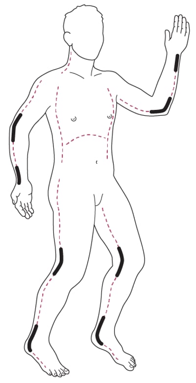 Escharotomy incision sites