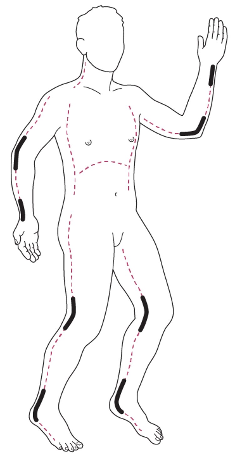 Escharotomy incision sites