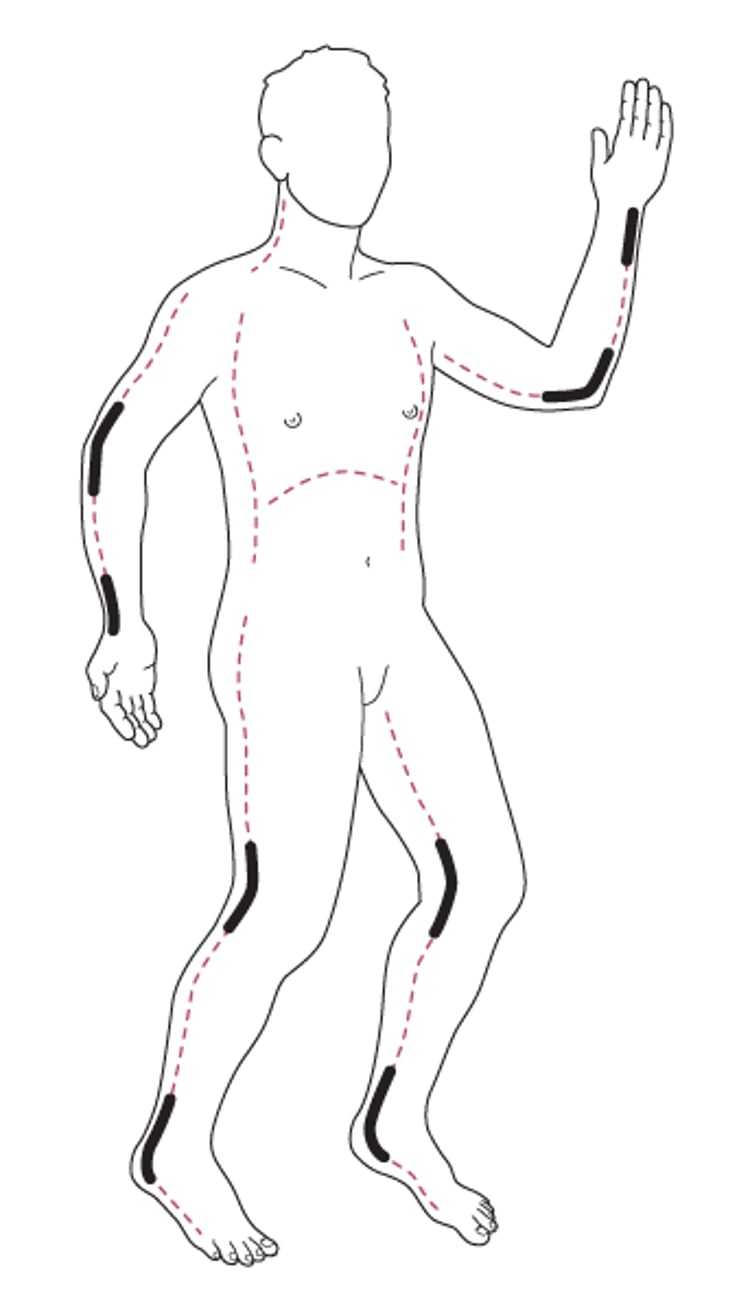 Sitios de incisión para la escarotomía
