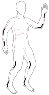 Sites d'incision d'escharotomie