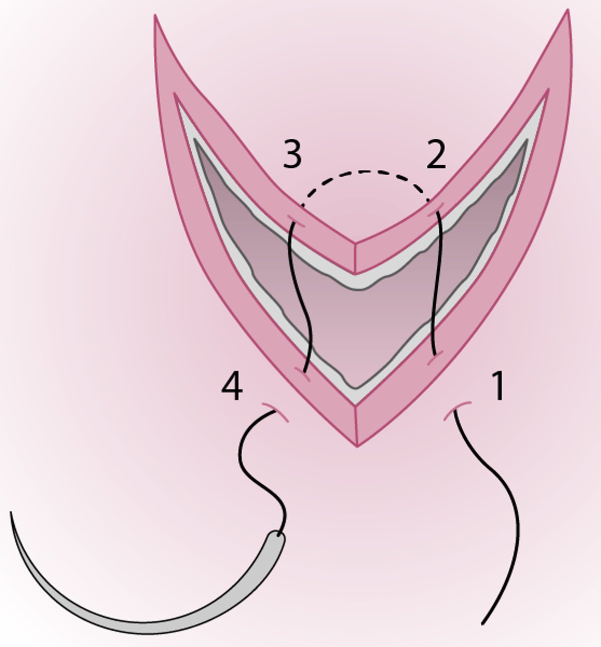 Flap Laceration Repair