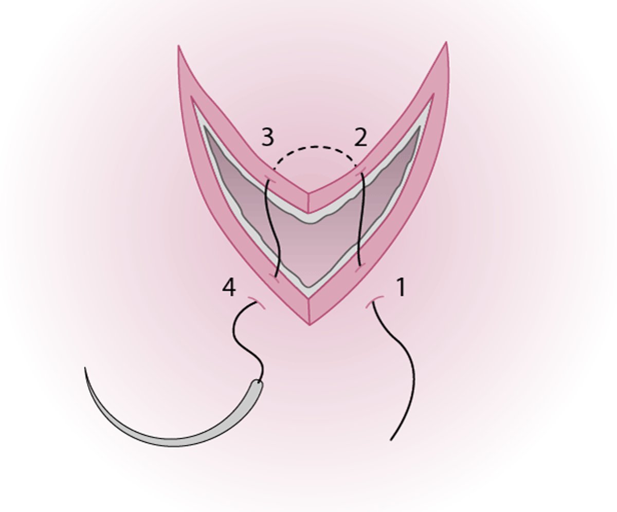 Réparation des lacérations par lambeau