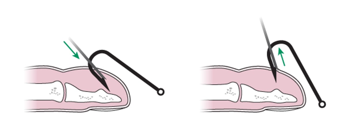 Fish Hook Removal: Needle Cover Method