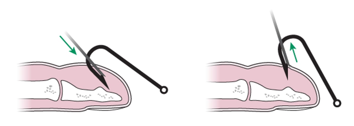 Extracción del anzuelo: método de cobertura de la aguja