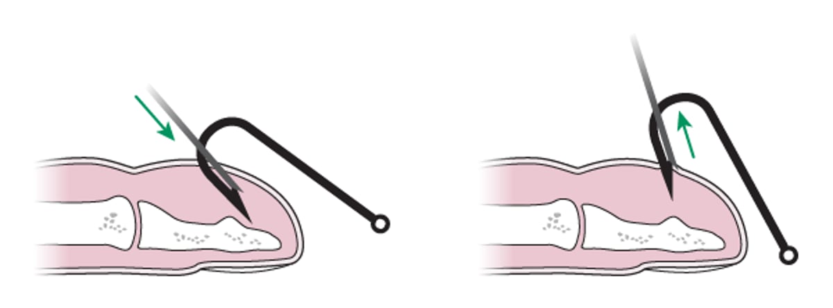 Ablation des hameçons: méthode de couverture par aiguille