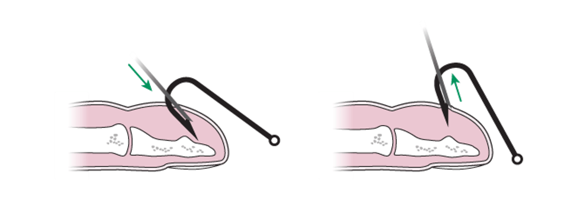 Ablation des hameçons: méthode de couverture par aiguille