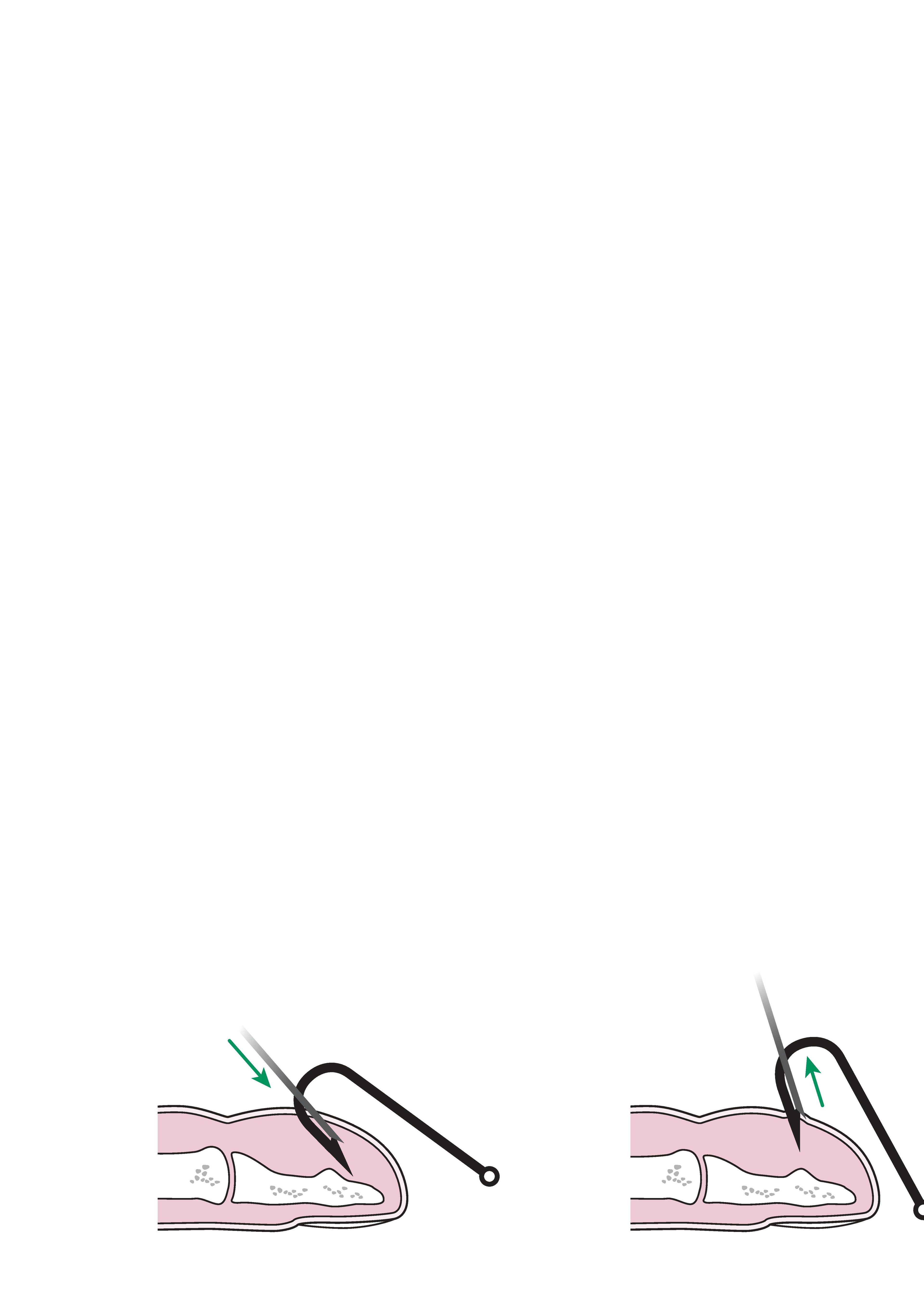 RIMUOVI GANCI SCIOGLITORI Per Tubi In Alluminio Accessori Pesca - Foto 5