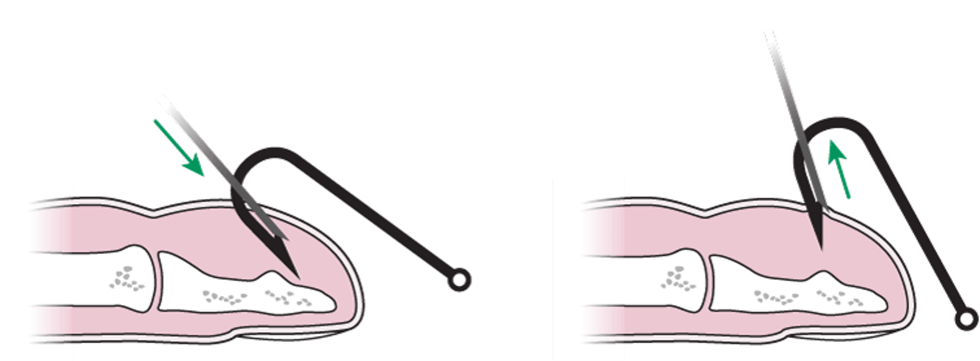 釣り針の抜去：針で覆う方法