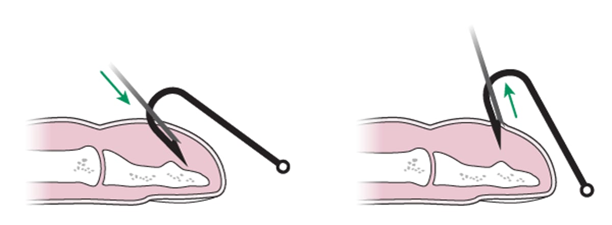 鱼钩去除：针套法