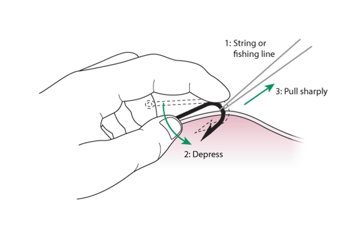 Fish hook removal: String method