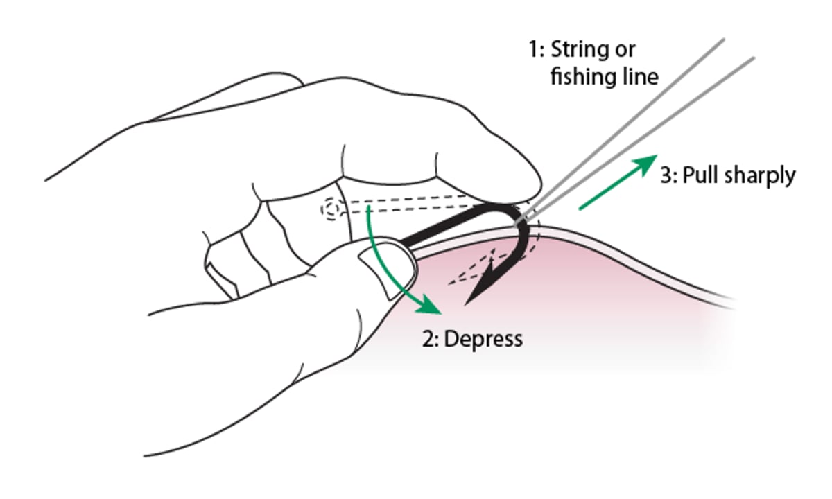 Extracción del anzuelo: método de cuerda
