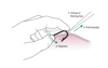 Ablation des hameçons: méthode de la ficelle