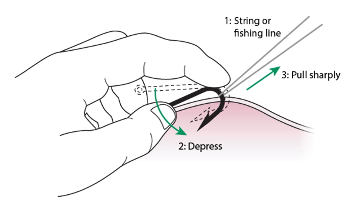Ablation des hameçons: méthode de la ficelle