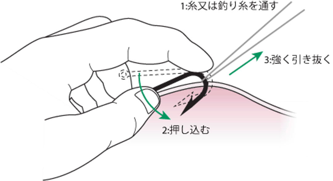 釣り針の抜去：string法
