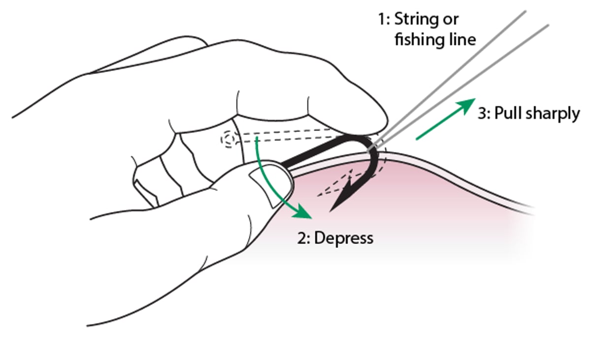 Remoção de anzol: método da linha