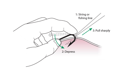 鱼钩去除：串线法