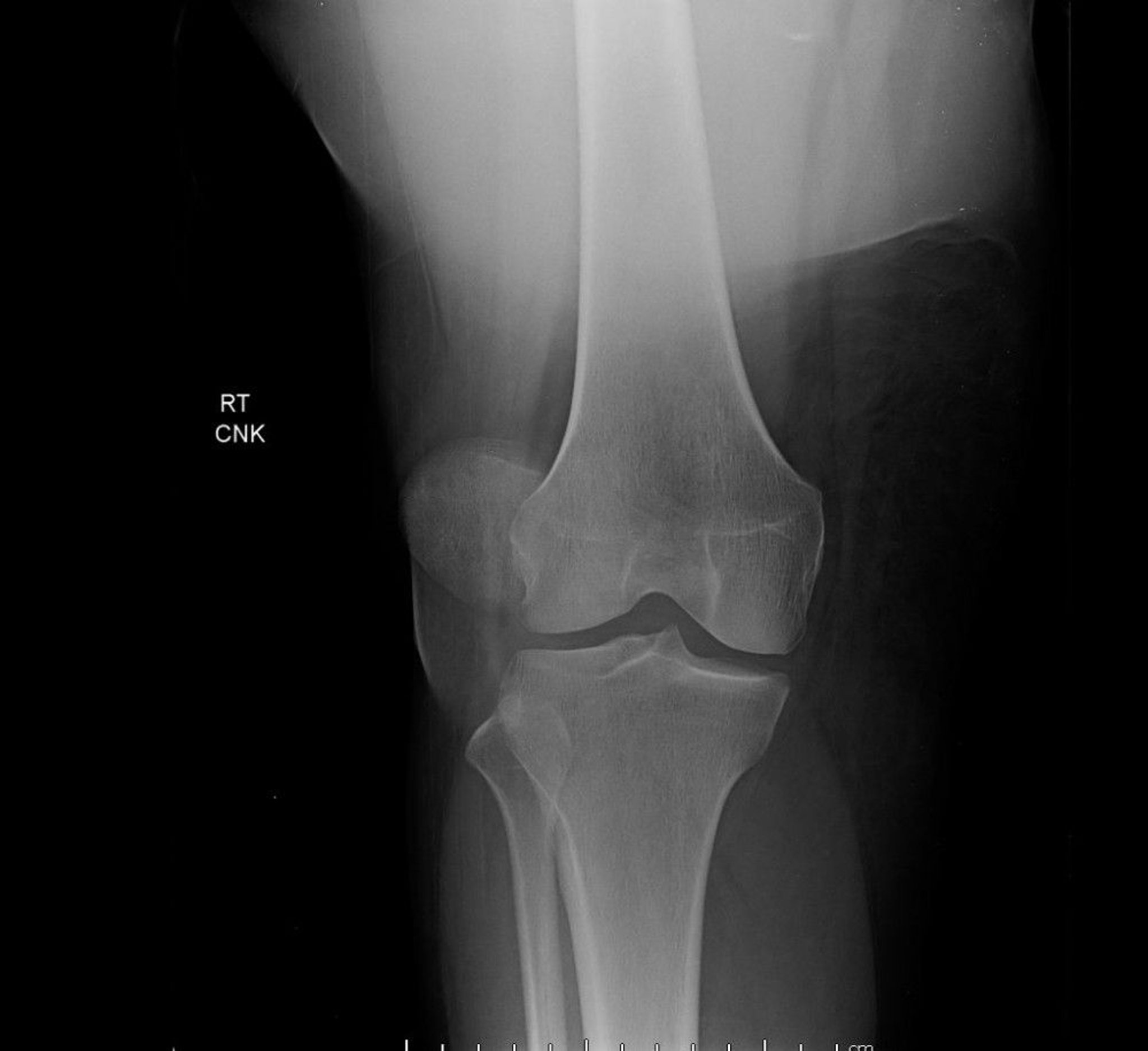 Patellar Dislocation (Radiograph)