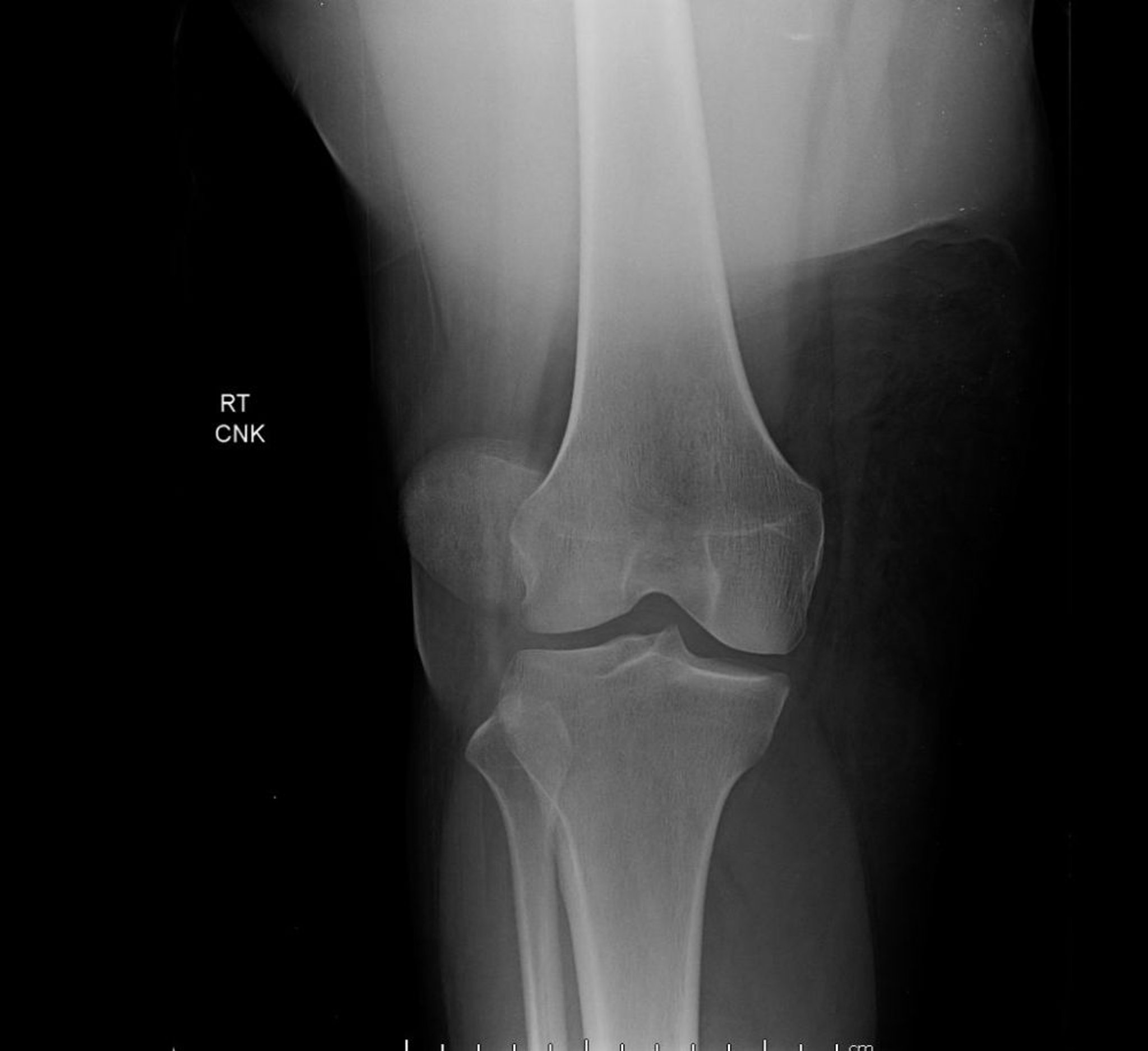 Luxation de la rotule (radiographie)
