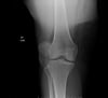 Deslocamento patelar (radiografia)
