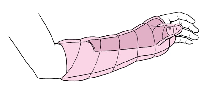 How To Apply a Thumb Spica Splint - Injuries; Poisoning - Merck Manual ...