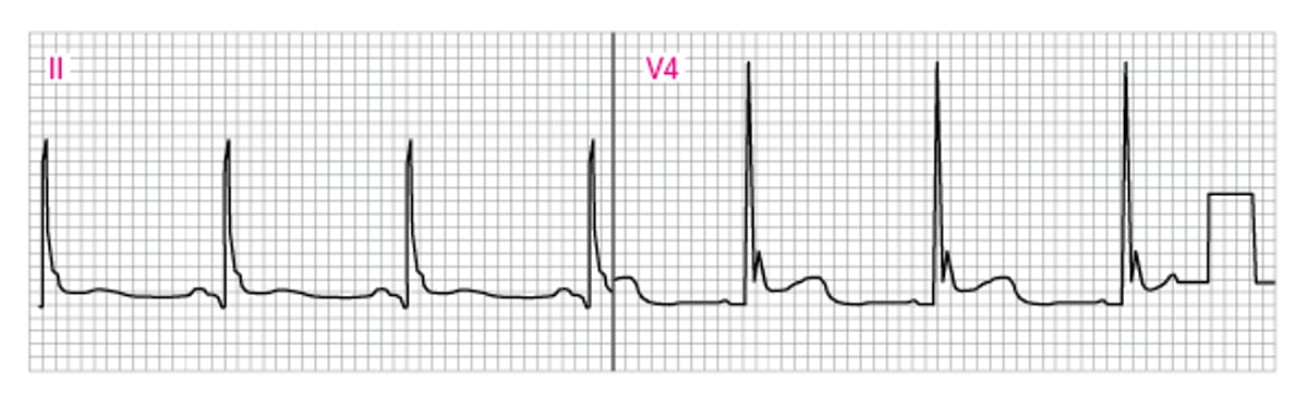 Abnormal ECG Showing J (Osborn) Waves (V4)