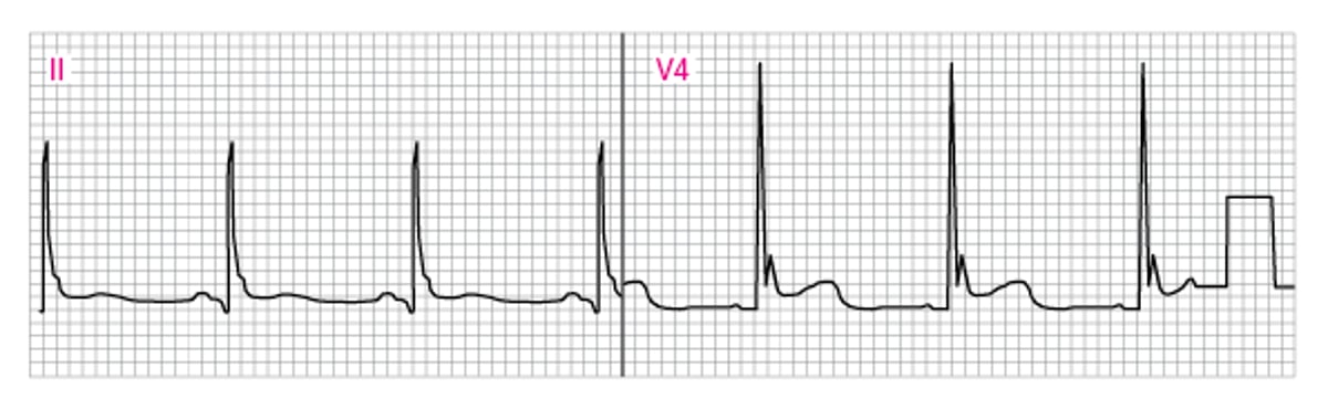 Abnormal ECG showing J (Osborn) waves (V4)