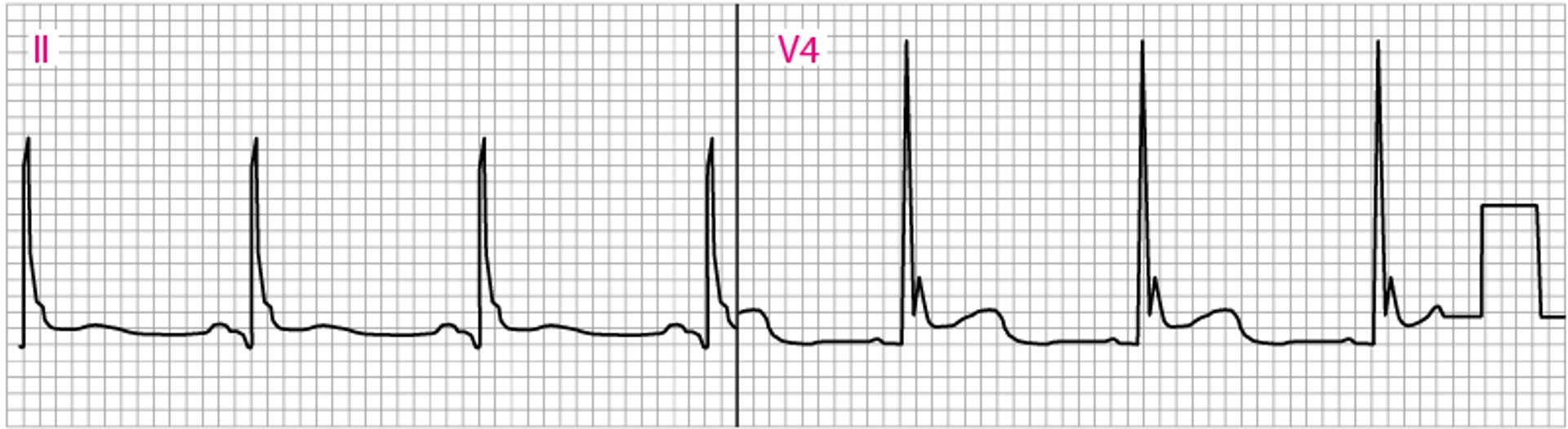 Abnormales EKG, J-(Osborn)-Wellen darstellend (V4)