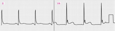El ECG anormal muestra ondas J (Osborn) (V4)