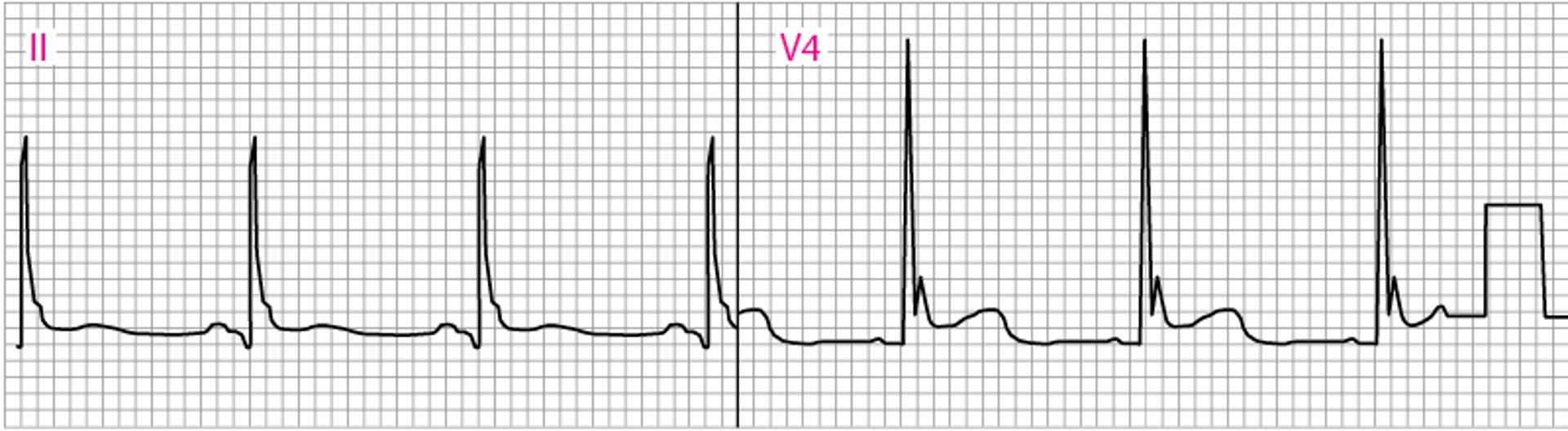 El ECG anormal muestra ondas J (Osborn) (V4)