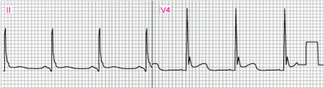 J（オズボーン）波（V4）を示す心電図異常